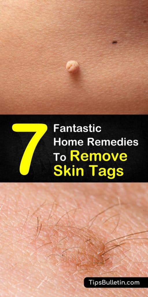 hymenal skin tag removal
